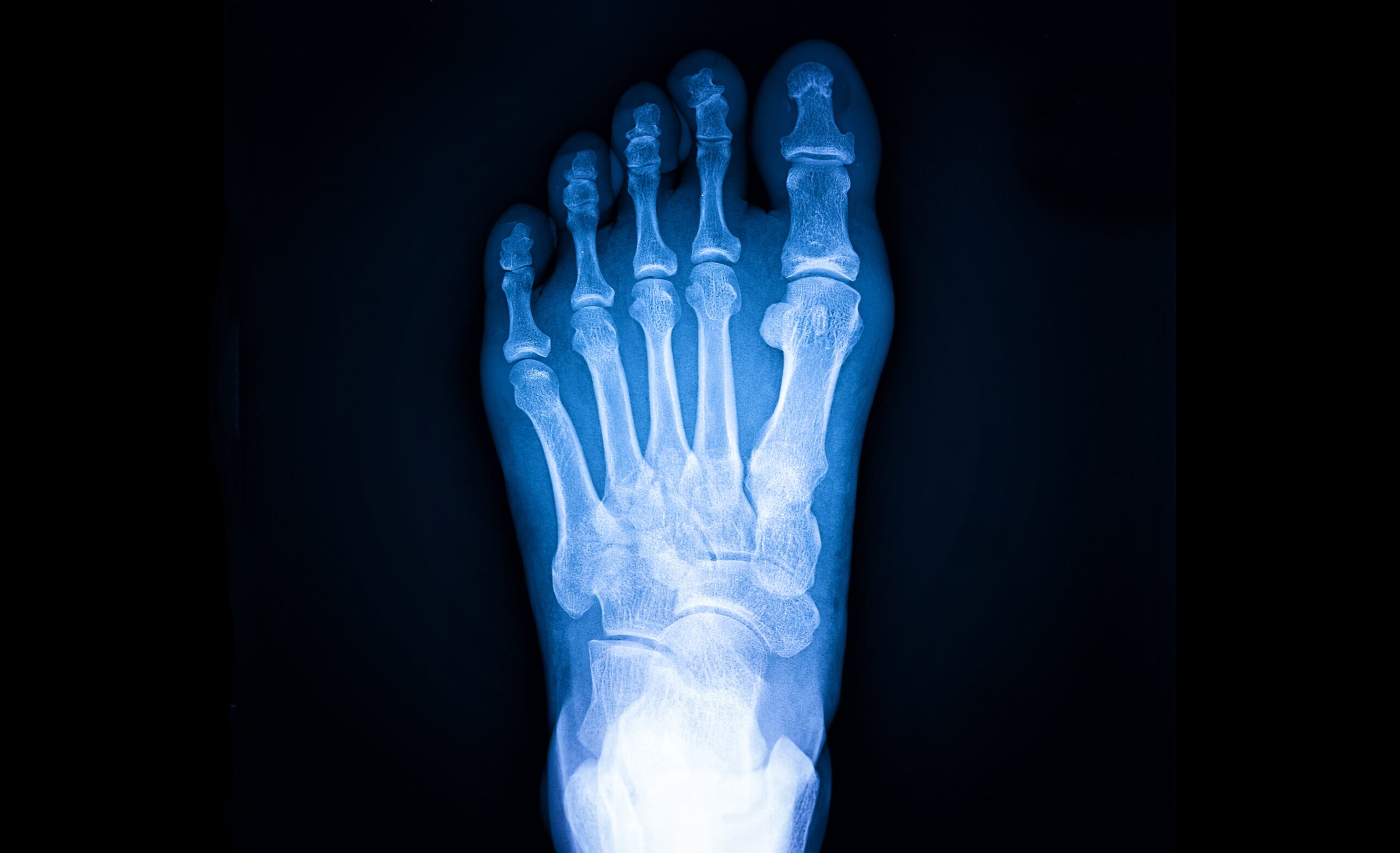 cartiva toe implant