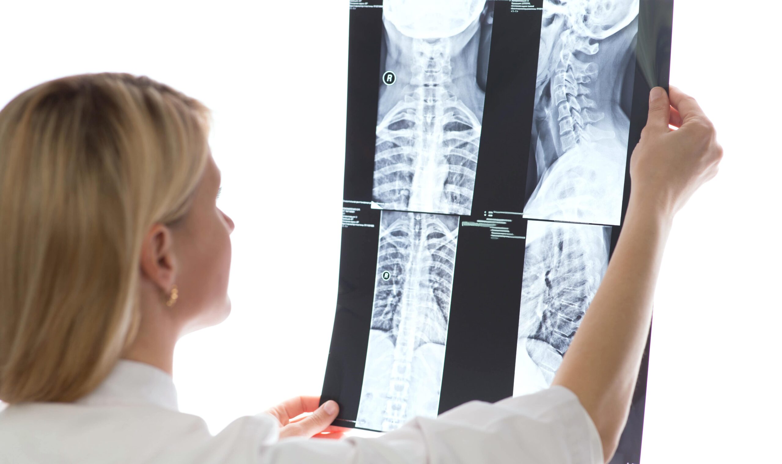 hidden costs of a spinal cord injury