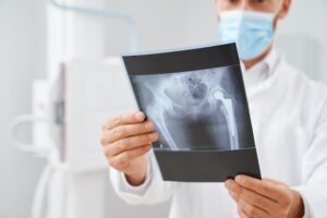 x-ray of a hip injury from hit and run